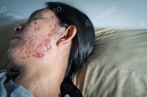 Preview: Acne on face because the disorders of sebaceous glands productions. Acne or a Cosmetic Allergy.