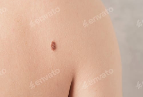 Preview: Close-up of a mole on a person's back