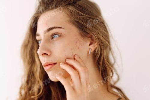 Preview: Portrait of a beautiful young woman with inflammations on the skin of her face. Acne disease.