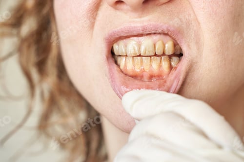 Preview: Female Caucasian adult teeth with plaque and gum irritation close up