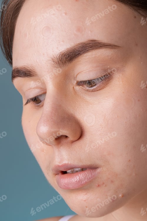 Preview: Girl with acne stick round acne patch on her cheek