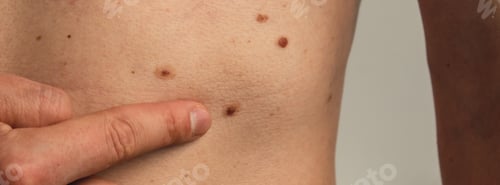Preview: Male hand showing birthmarks on skin body stomach part. Close up detail of the bare skin. Health