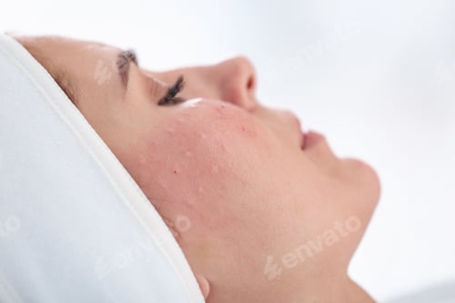 Preview: Woman after face biorevitalization procedure in salon, closeup. Cosmetic treatment
