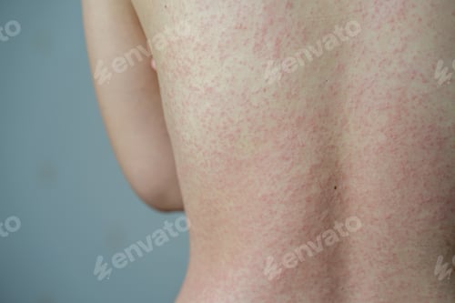 Preview: Closeup of a woman's back covered in acne on a blurred grayish-blue background