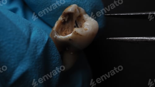 Preview: Tooth decay and dentist hand with glove and black background.