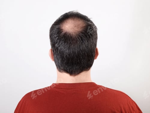 Preview: back of male head with thinning hair or alopecia or hair loss