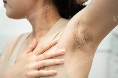 Preview: Asian woman have problem black armpit beauty skin care.