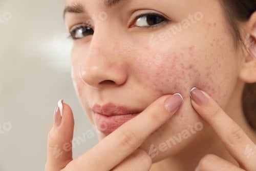 Preview: Teen girl with acne problem squeezing pimple on her face, closeup