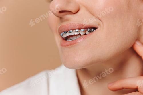 Preview: Close-up of a woman with braces on a beige background