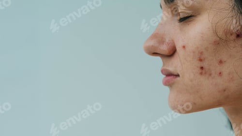 Preview: portrait of a young woman with skin problems - pimples, acne, enlarged pores.