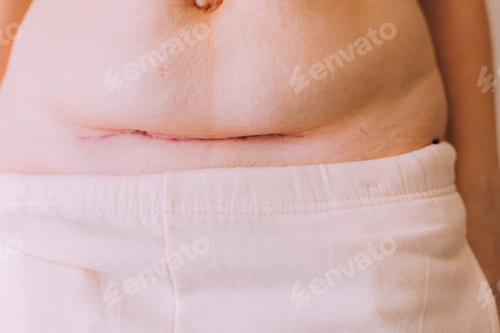 Vista previa: Suture after cesarean section lifestyle