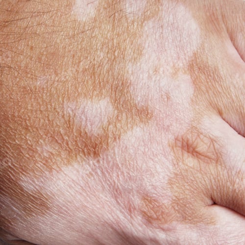 Preview: Vitiligo