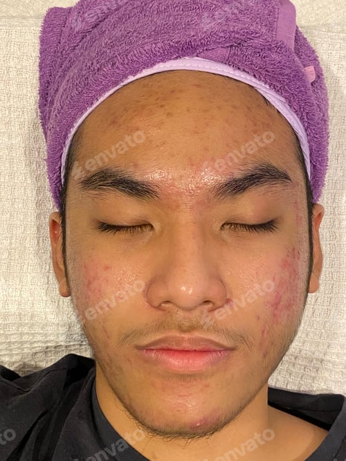 Preview: Acne problems and deep scarring on a teenage boy face