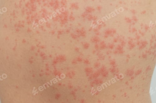 Preview: Urticaria is an allergic reaction on the skin. Red spots on the skin