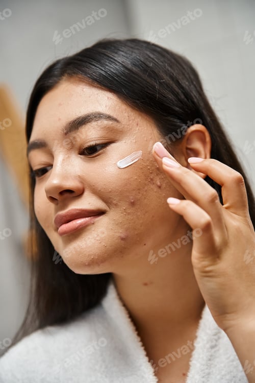 Preview: acne treatment cream on face of young asian woman with brunette hair looking away, close up