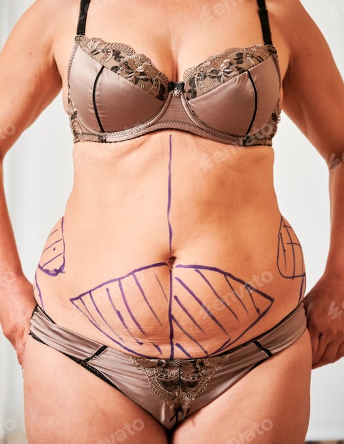 Preview: Woman body with marks for plastic surgery.