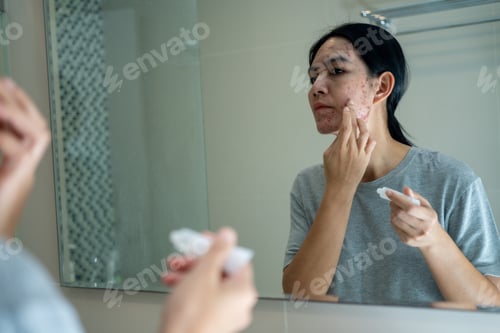 Preview: Acne on face because the disorders of sebaceous glands productions. Acne or a Cosmetic