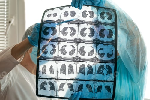 Preview: doctor examine the result of computed tomography of a patient with bilateral polysigmental pneumonia