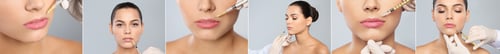 Vista previa: Collage with photos of woman during lip augmentation procedure. Banner design