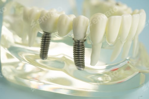 Preview: Dental implant, artificial tooth roots into jaw, root canal of dental treatment