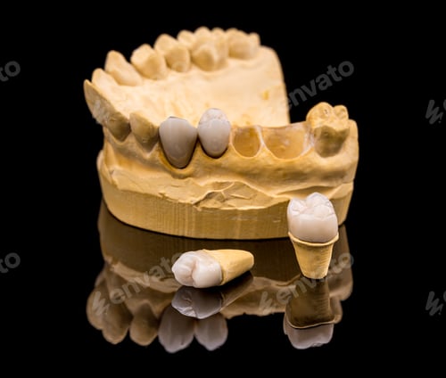 Preview: Dental prosthesis