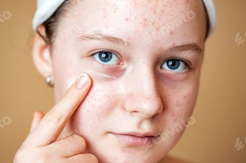 Preview: Problematic skin. Acne and red festering pimples on the face of a young girl using cream.