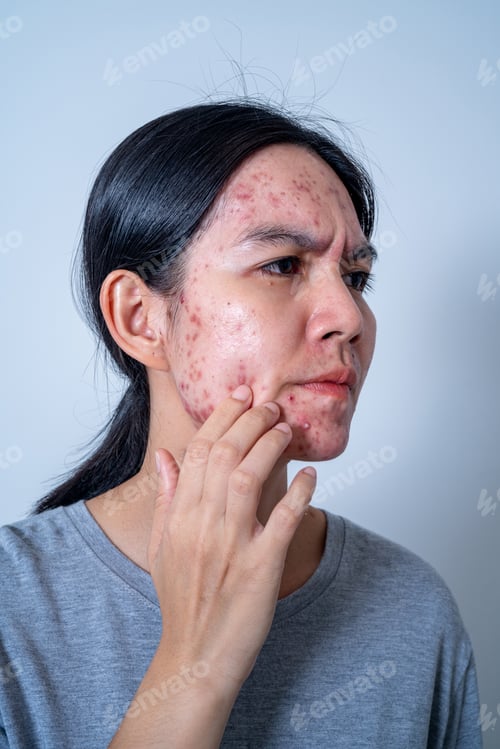 Preview: Acne on face because the disorders of sebaceous glands productions. Acne or a Cosmetic