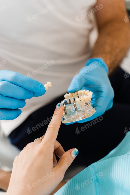 Preview: Artificial plastic jaw with dental implants shown in close-up for dental consultation