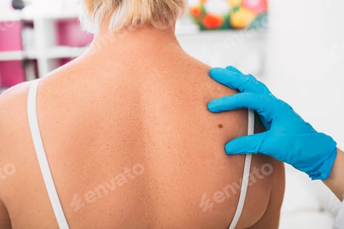 Preview: Doctor dermatologist examining senior patients mole at clinic