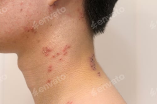 Preview: close up of man with shingles disease on skin
