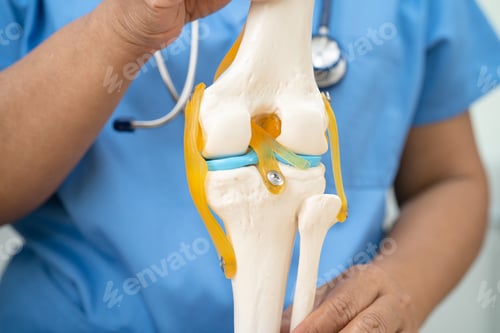 Preview: Osteoarthritis of the knee, Doctor holding human knee joint orthopedic anatomy model in hospital.
