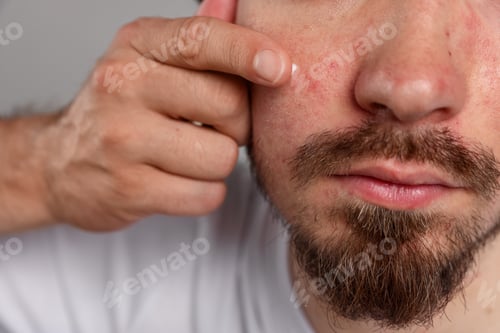 Preview: Young man with acne problem applying cream onto his face on light grey background, closeup