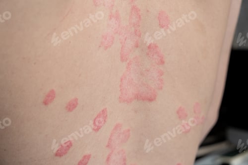 Preview: Psoriasis Vulgaris, skin patches are typically red, itchy, and scaly.
