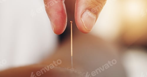 Preview: Acupuncture, needles and skin with hand in closeup, alternative medicine or healing therapy. Relax,