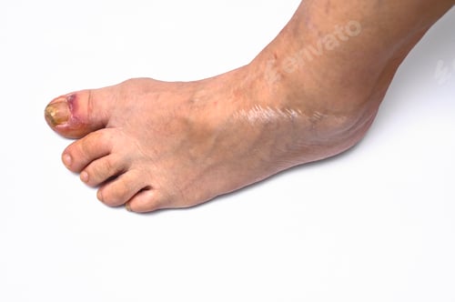 Preview: fungus on the nail. on a white background