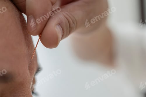 Preview: Practitioner inserting acupuncture needle into client's face