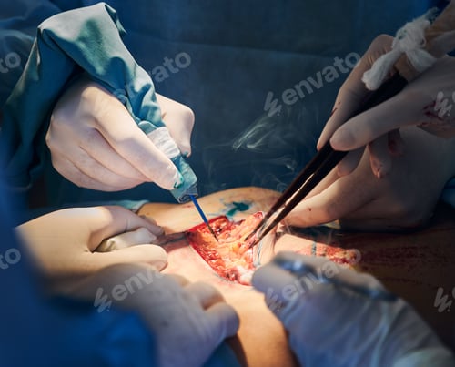 Preview: Medical team doing abdominoplasty surgery in clinic.