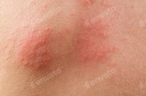 Preview: chickenpox rash. Shingles, varicella-zoster virus. skin rash and blisters on body