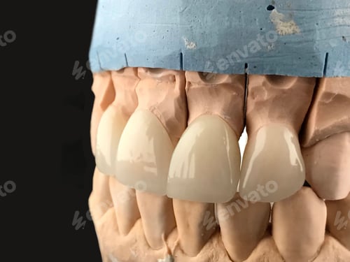 Preview: Mouth model with porcelain teeth. Press ceramic crowns and veneers a 1 color.