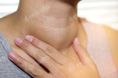 Preview: Asian lady woman patient have abnormal enlargement of thyroid gland Hyperthyroidism at the throat.