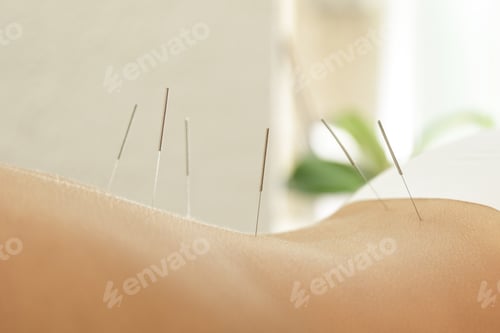 Preview: Female back with steel needles during procedure of acupuncture therapy