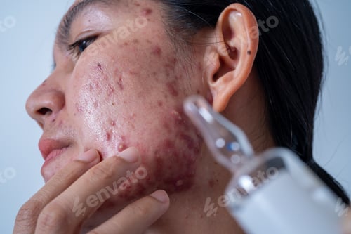 Preview: Acne on face because the disorders of sebaceous glands productions. Acne or a Cosmetic