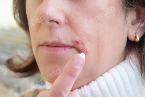 Preview: herpes on the lips, part of a woman's face with finger on lips with herpes, beauty concept