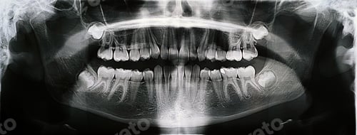Preview: Panoramic X-ray of the jaw. X-ray of the teeth of a 12-year-old girl