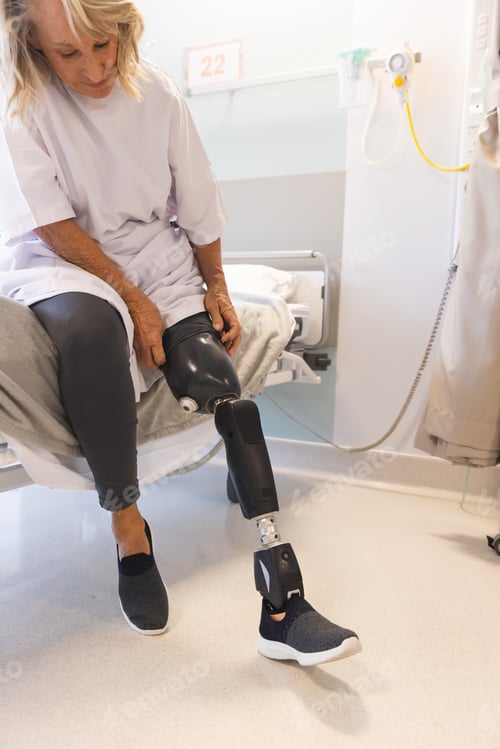 Preview: Senior caucasian female patient with prosthetic leg sitting on bed at hospital