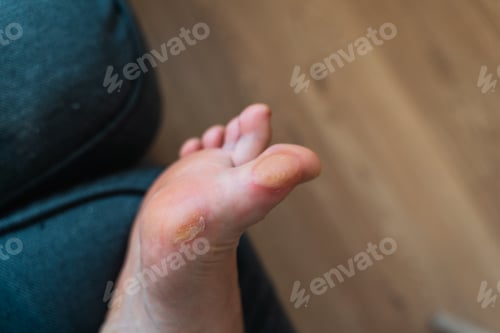 Preview: Close-up of a soft callus on a foot of a woman, sport shoes problem, corn on the leg. blister on the