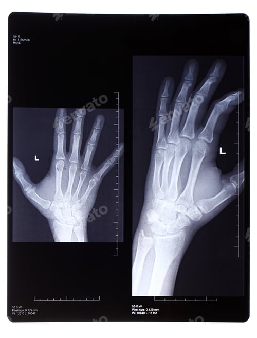 Preview: Xray of broken hand