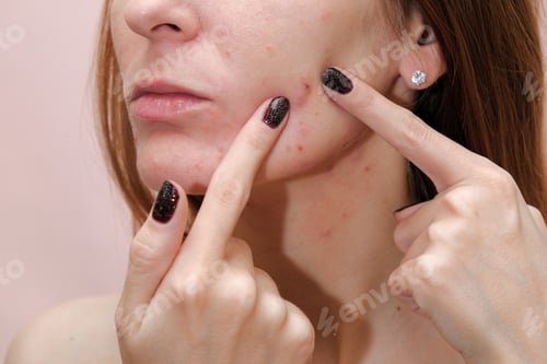 Preview: Woman With Problem Skin. Teen Acne On Young Skin. Tools For Removing Acne.