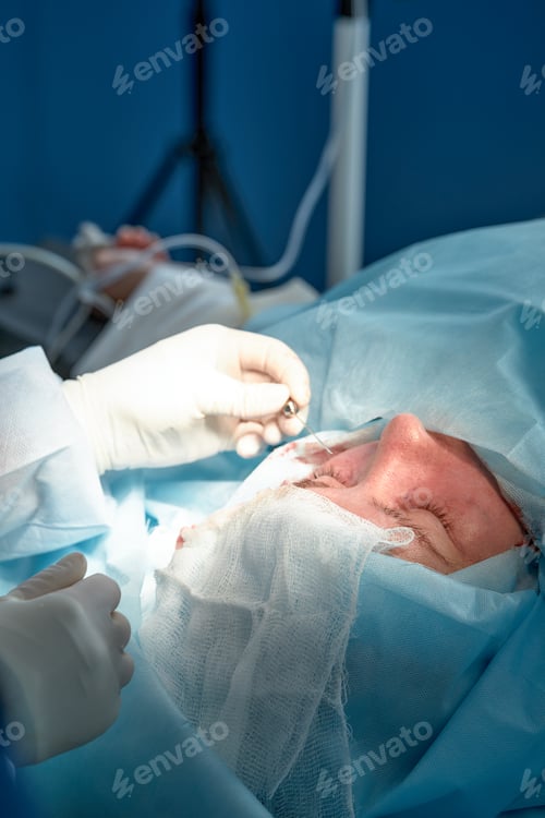Preview: Close up of the face of a patient who is undergoing blepharoplasty. The surgeon cuts the eyelid and