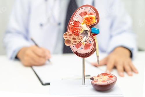 Preview: Kidney disease, Chronic kidney disease ckd, Doctor hold human